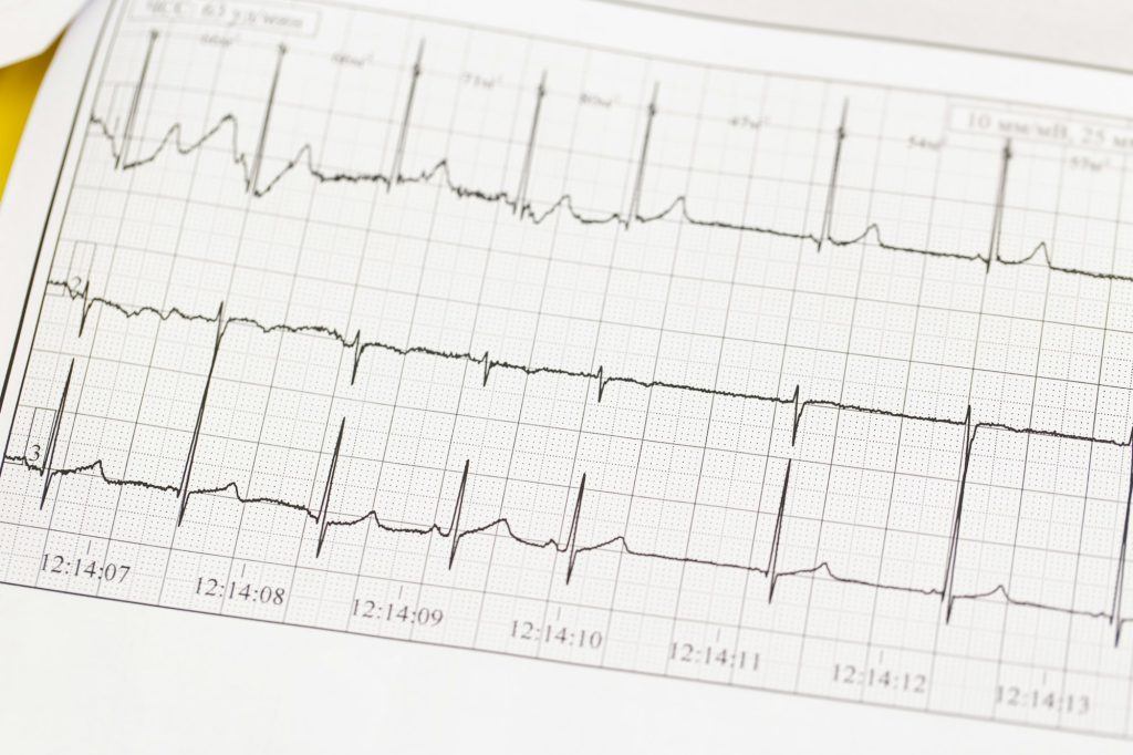 Close up of ECG, electrocardiogram. The work of a healthy heart on paper.