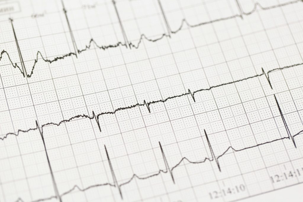 Close up of ECG, electrocardiogram. The work of a healthy heart on paper.