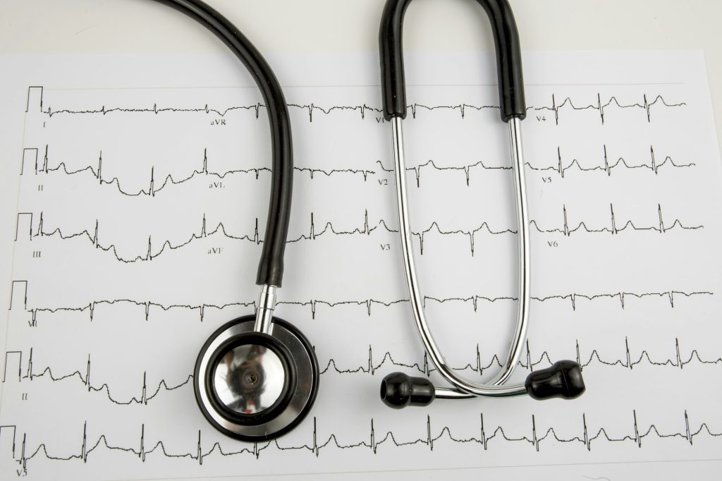 Stethoscope on the electrocardiogram (ECG) graph (top view)